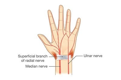 Diagram of a hand illustrating the radial, ulnar, and median nerves crossing the wrist.